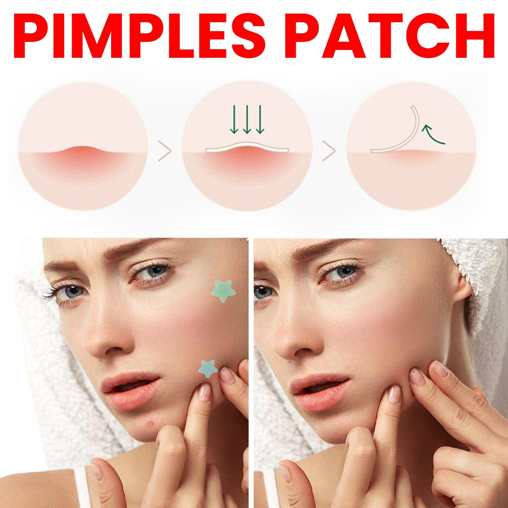 Patch Anti-Acné Réparateur – 200 Patchs Hydrocolloïdes, Tous Types de Peau 🌿✨ Yiwu Ruijia Auto Supplies Co., Ltd.